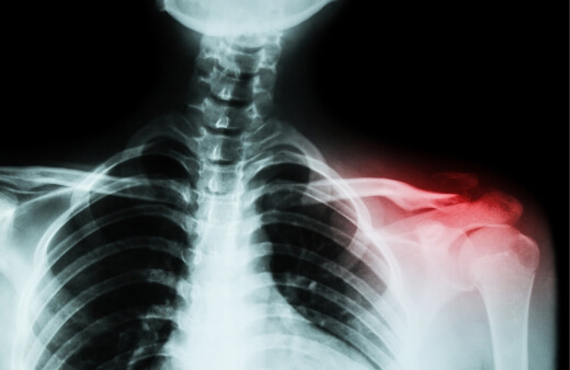 Clavicle fracture is a common soccer injury